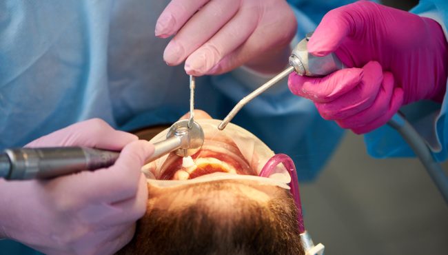 Closeup of a scaling and polishing procedure performed by two dentists in pink gloves to a male client.