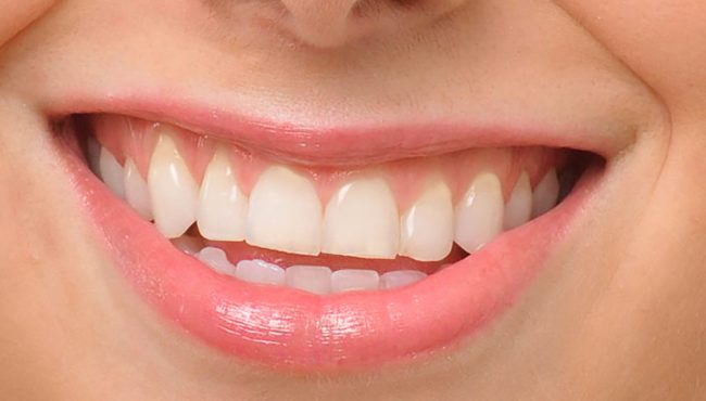 closeup of smile with white healthy teeth AFTER TEETH WHITENING TREATMENT