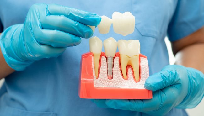 Dental implant, artificial tooth roots into jaw, root canal of dental treatment, gum disease, teeth model for dentist studying about dentistry.