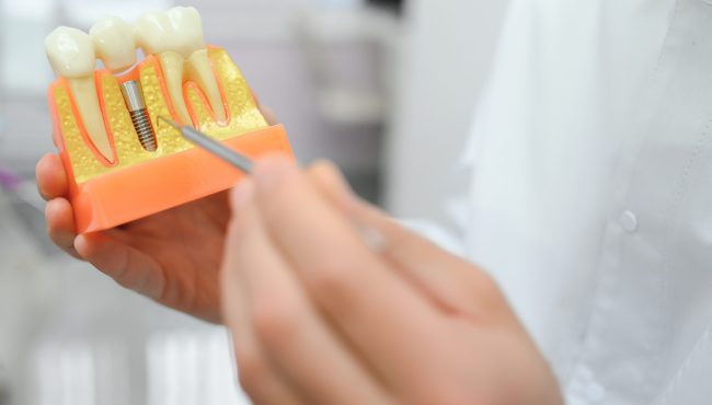 Doctor shows on a plastic tooth sample or model different methods of Dental Implants treatment.
