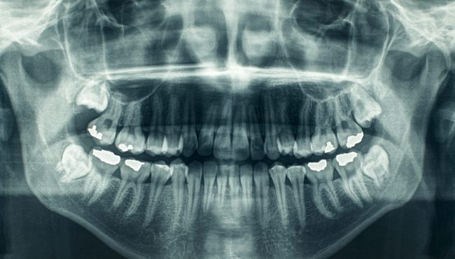 Panoramic dental X-ray showing healthy teeth and jaw structure, provided by Thanks Dental and Aesthetics.